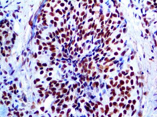 IHC of INI-1 on an FFPE Ewing’s Sarcoma Tissue